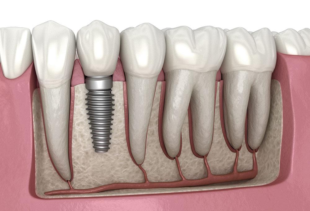 Dental Implants vs Dental Check-Up in Türkiye: Which Should You Book First? - Turkey travel guide, tips and tour insights | My Turkey Adventure